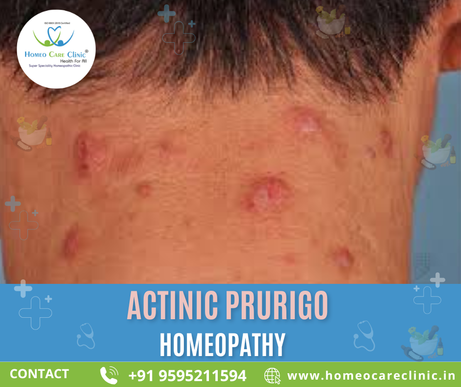 homeopathy treatment for Actinic Prurigo