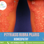 Pityriasis Rubra Pilaris symptoms