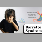 Barrett’s Disease causes