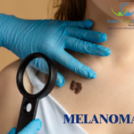 Homeopathy for malignant melanoma with natural treatment focus