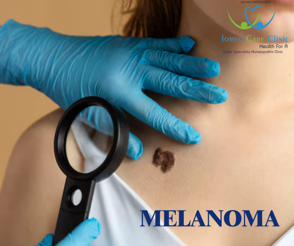 Homeopathy for malignant melanoma with natural treatment focus