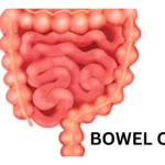 Bowel cancer diagnosis and treatment options