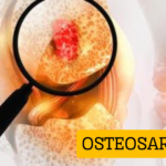 Osteosarcoma symptoms and treatment