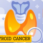 treatment options for parathyroid cancer