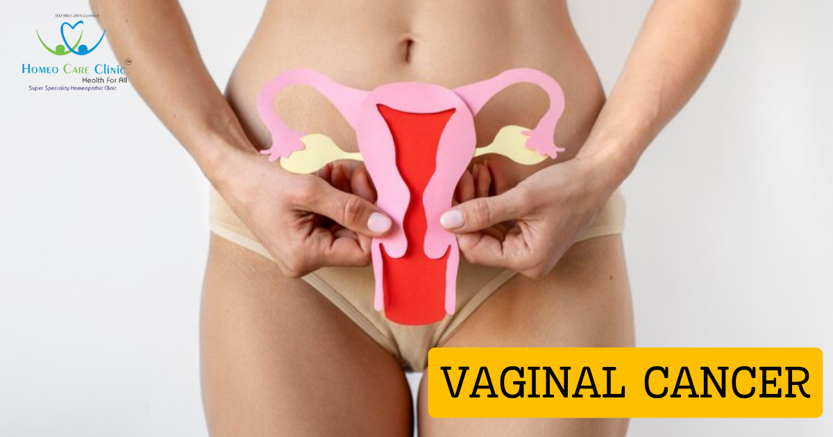 Vaginal Cancer: Causes and Treatment