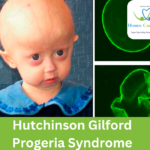 Facial characteristics of a child with progeria syndrome.