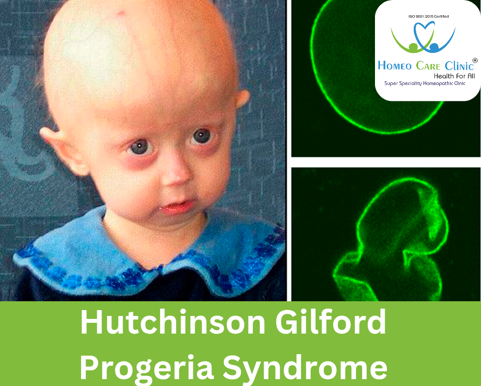 Facial characteristics of a child with progeria syndrome.