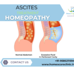 Homeopathy for ascites and natural fluid drainage