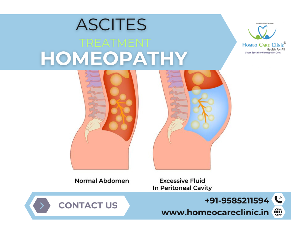 Homeopathy for ascites and natural fluid drainage