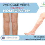 Homeopathic treatment for varicose veins naturally