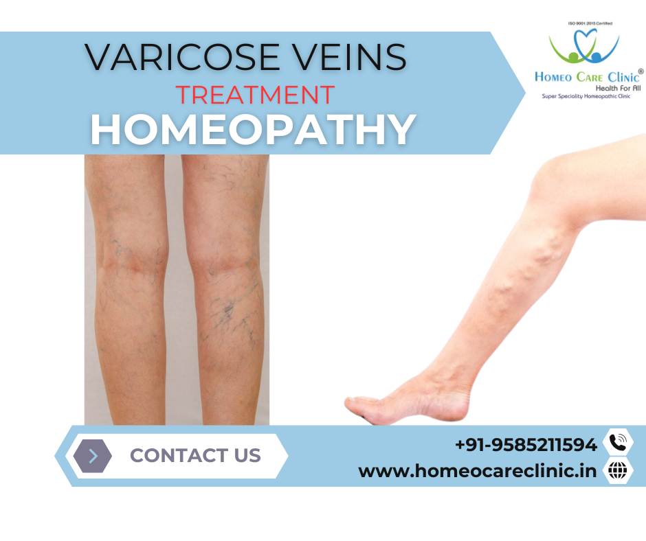 Homeopathic treatment for varicose veins naturally