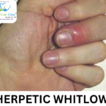 Fingers with fluid-filled blisters caused by Herpetic Whitlow.