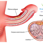 Peyronie’s Disease treatment