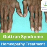 Gottron Syndrome causes & treatment