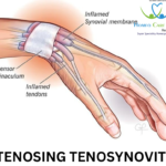 Stenosing Tenosynovitis