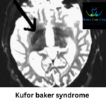 Overview of Kufor-Rakeb Syndrome