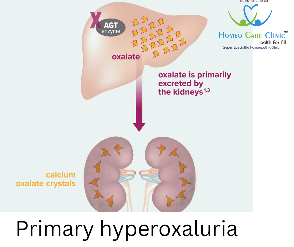 Homeopathic treatment for Primary Hyperoxaluria