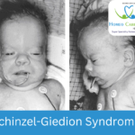 homeopathic treatments for Schinzel-Giedion Syndrome