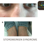 Stormorken Syndrome symptoms