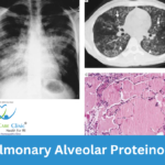 Lungs Affected by Pulmonary Alveolar Proteinosis