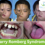 Medical illustration of Parry-Romberg Syndrome facial changes