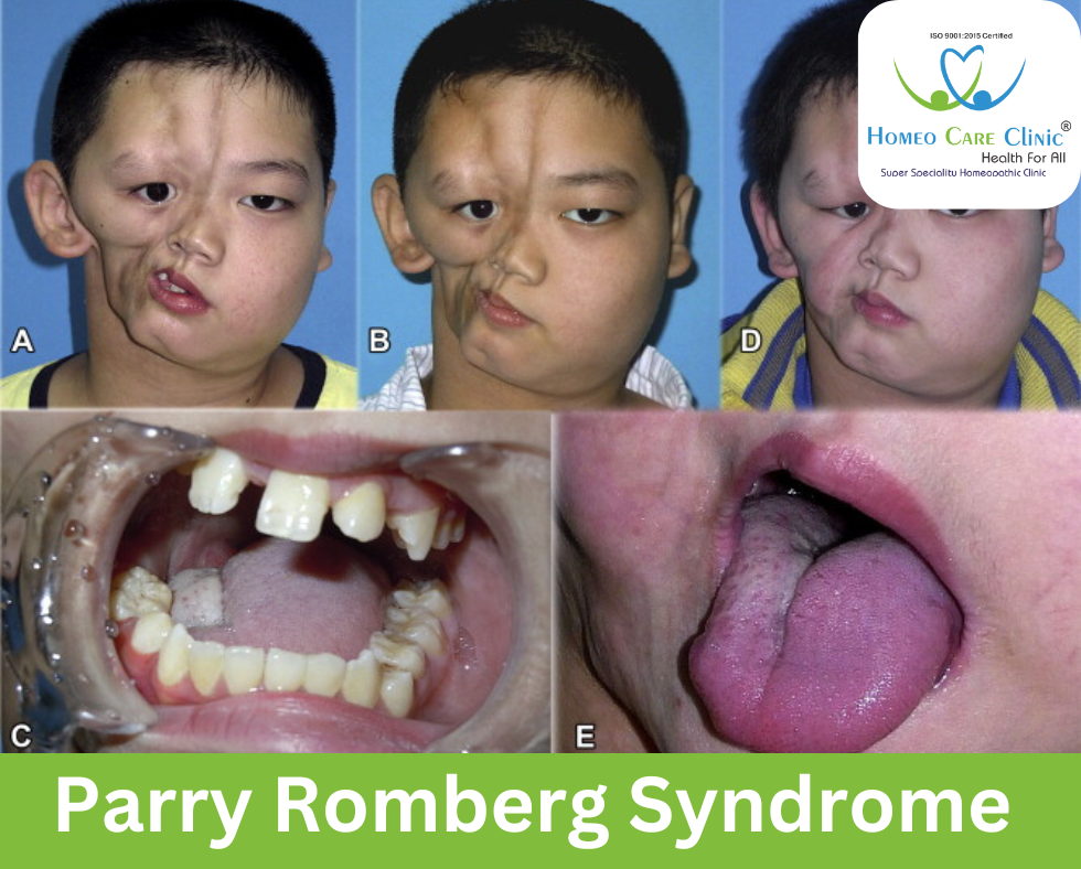 Medical illustration of Parry-Romberg Syndrome facial changes