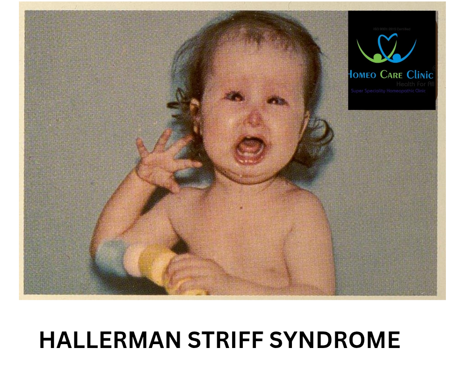 Hallermann-Streiff Syndrome Symptoms