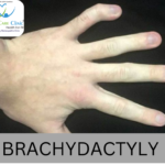 Brachydactyly symptoms and homeopathy treatment