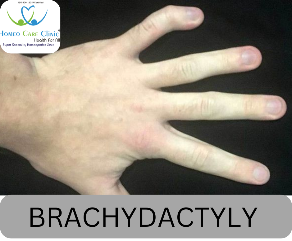 Brachydactyly symptoms and homeopathy treatment