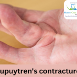 Homeopathic treatment for Dupuytren’s Contracture