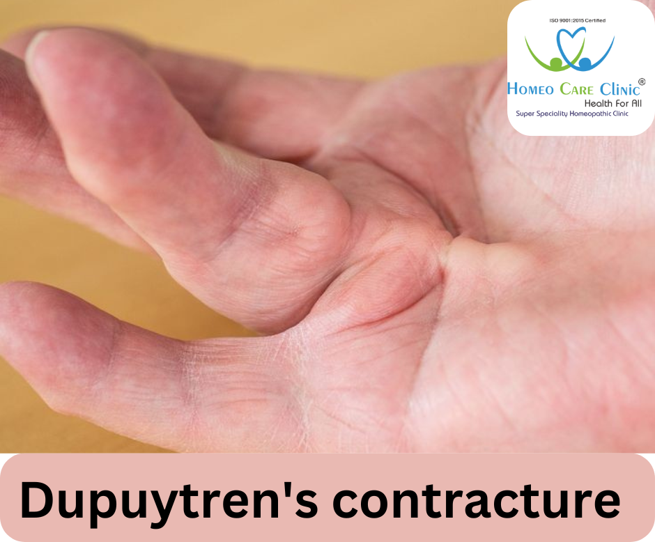 Homeopathic treatment for Dupuytren’s Contracture