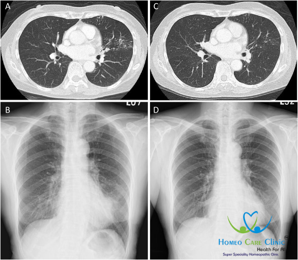 MAC lung disease symptoms