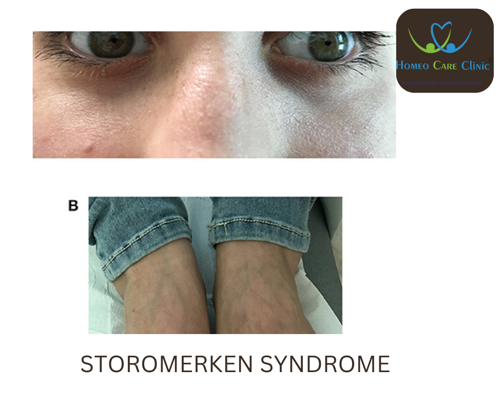 Stormorken Syndrome symptoms
